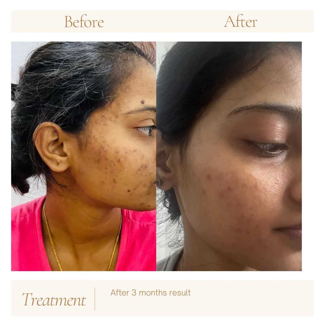 Clear skin transformation after 3 months of acne scar treatment with Shrinika Dermacare.