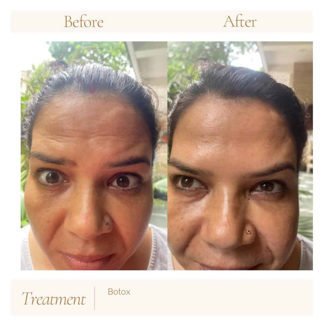 Vailing skin after Botox treatment, with smoother forehead and fewer wrinkles.