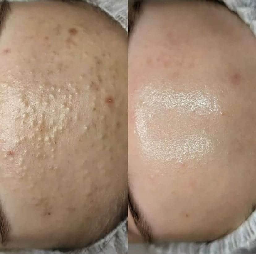 Acne treatment