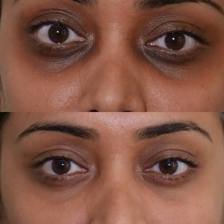 Dark circle treatment