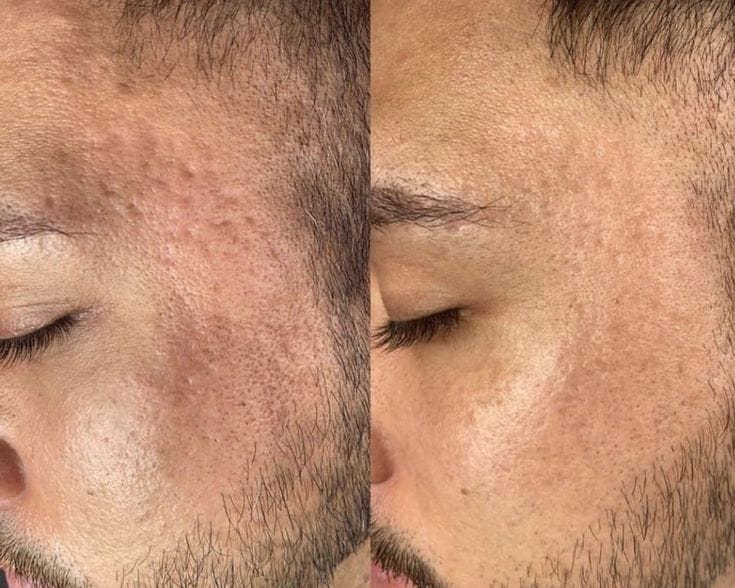 Scar treatment