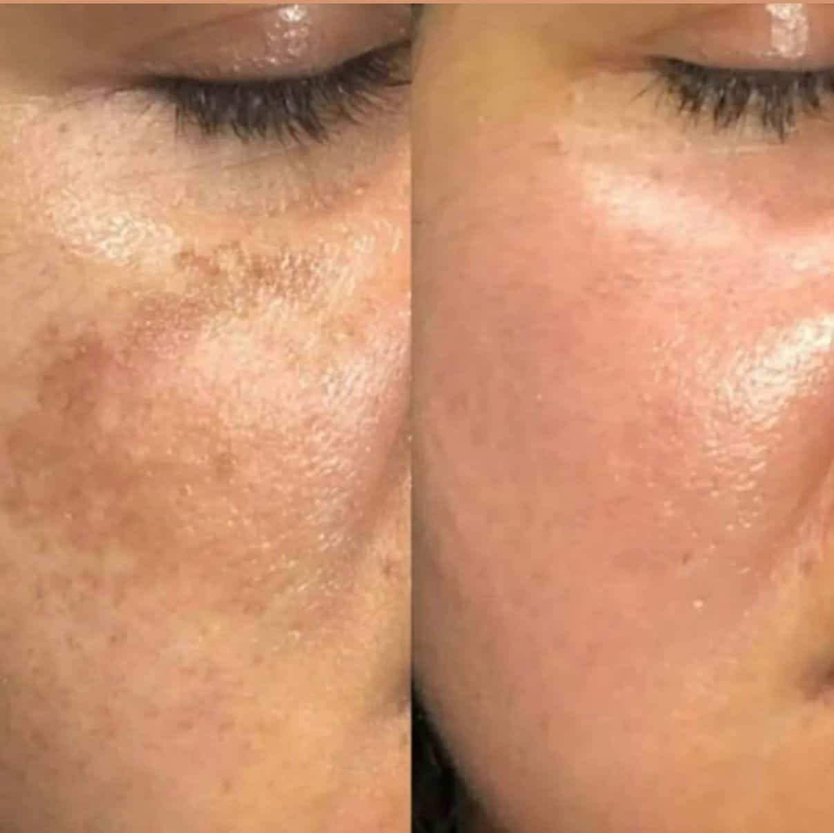 Pigmentation
