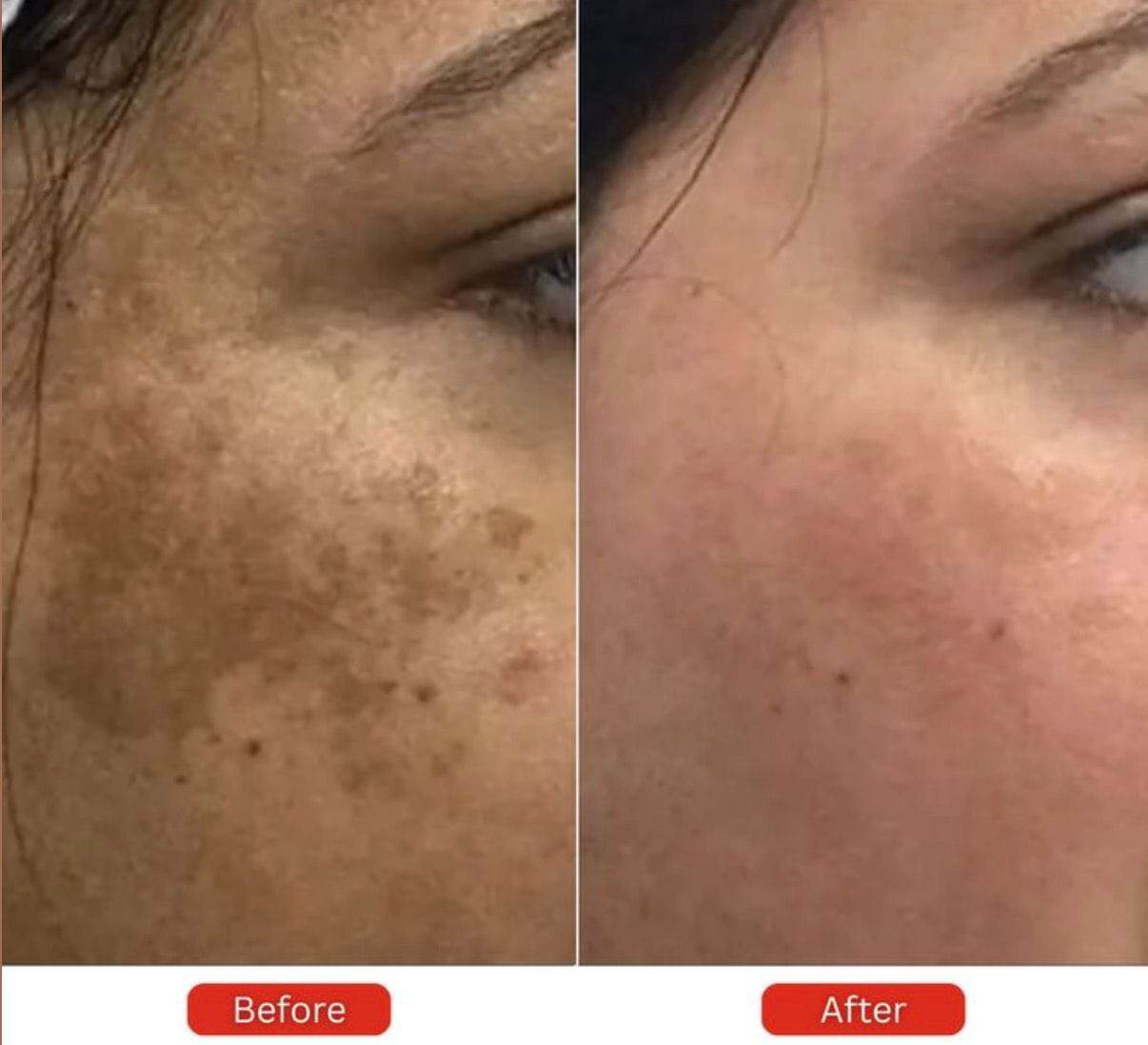 Pigmentation Treatment