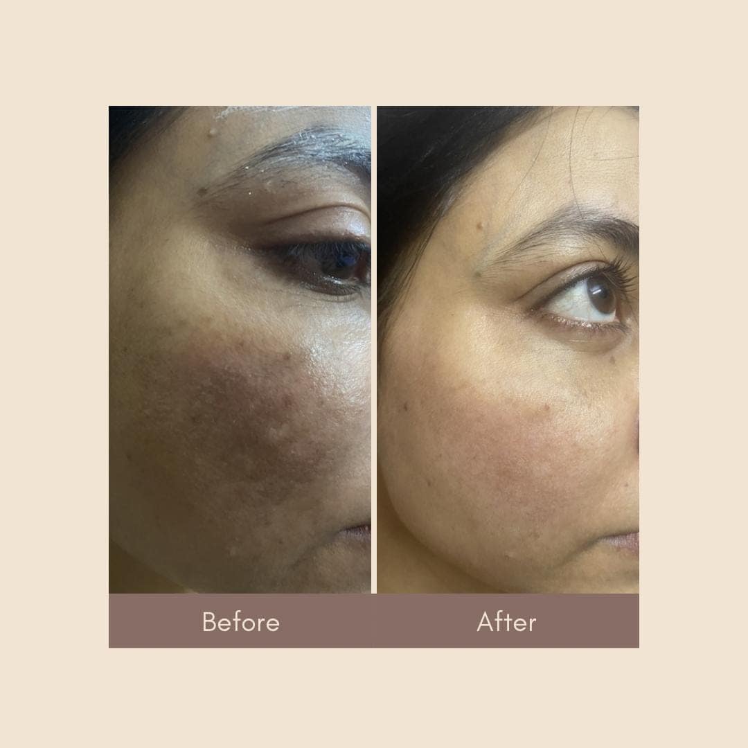 pigmentation treatment